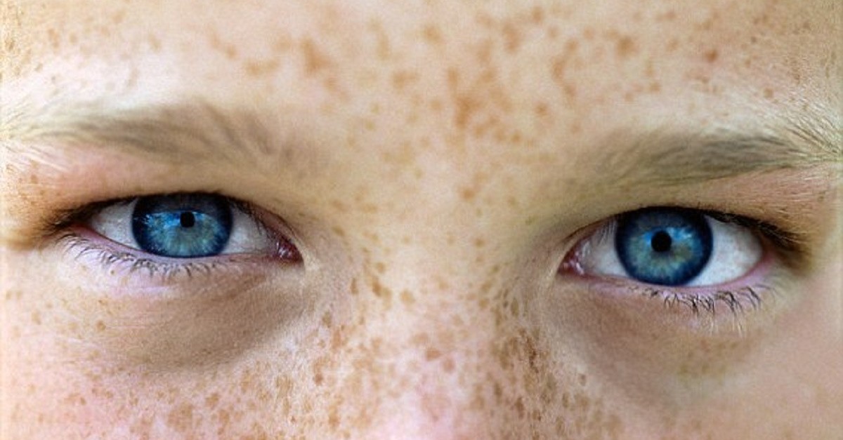 Глаза в разные стороны болезнь. Веснушки глаз человека. Boy with Freckles.