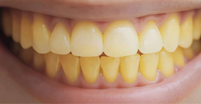 Dentista revela ERRO COMUM que muita gente comete e que faz seus dentes pareceram MAIS AMARELADOS