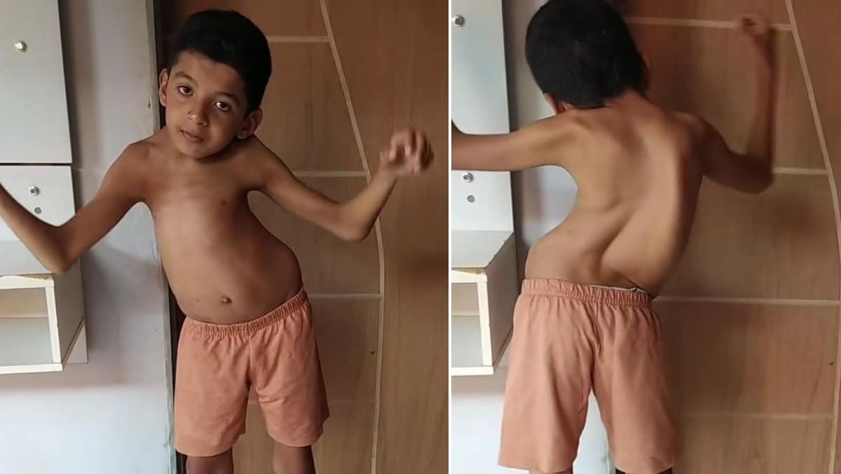 revistapazes.com - Madrasta luta para conseguir cirurgia de enteado que possui escoliose gravíssima: 'Amo ele como se fosse meu filho'