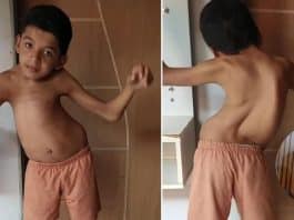 Madrasta luta para conseguir cirurgia de enteado que possui escoliose gravíssima: 'Amo ele como se fosse meu filho'