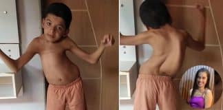 Madrasta luta para conseguir cirurgia de enteado que possui escoliose gravíssima: 'Amo ele como se fosse meu filho'