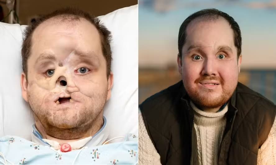 revistapazes.com - Homem recebe transplante de rosto inovador e recupera capacidade de sorrir e piscar - veja fotos do antes e depois