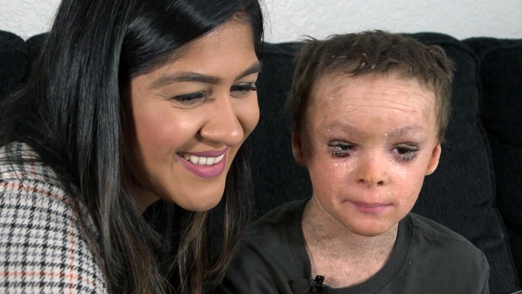 revistapazes.com - Menino de 7 anos com condição raríssima de pele consegue dormir com os olhos fechados pela 1ª vez após cirurgia que mudou sua vida